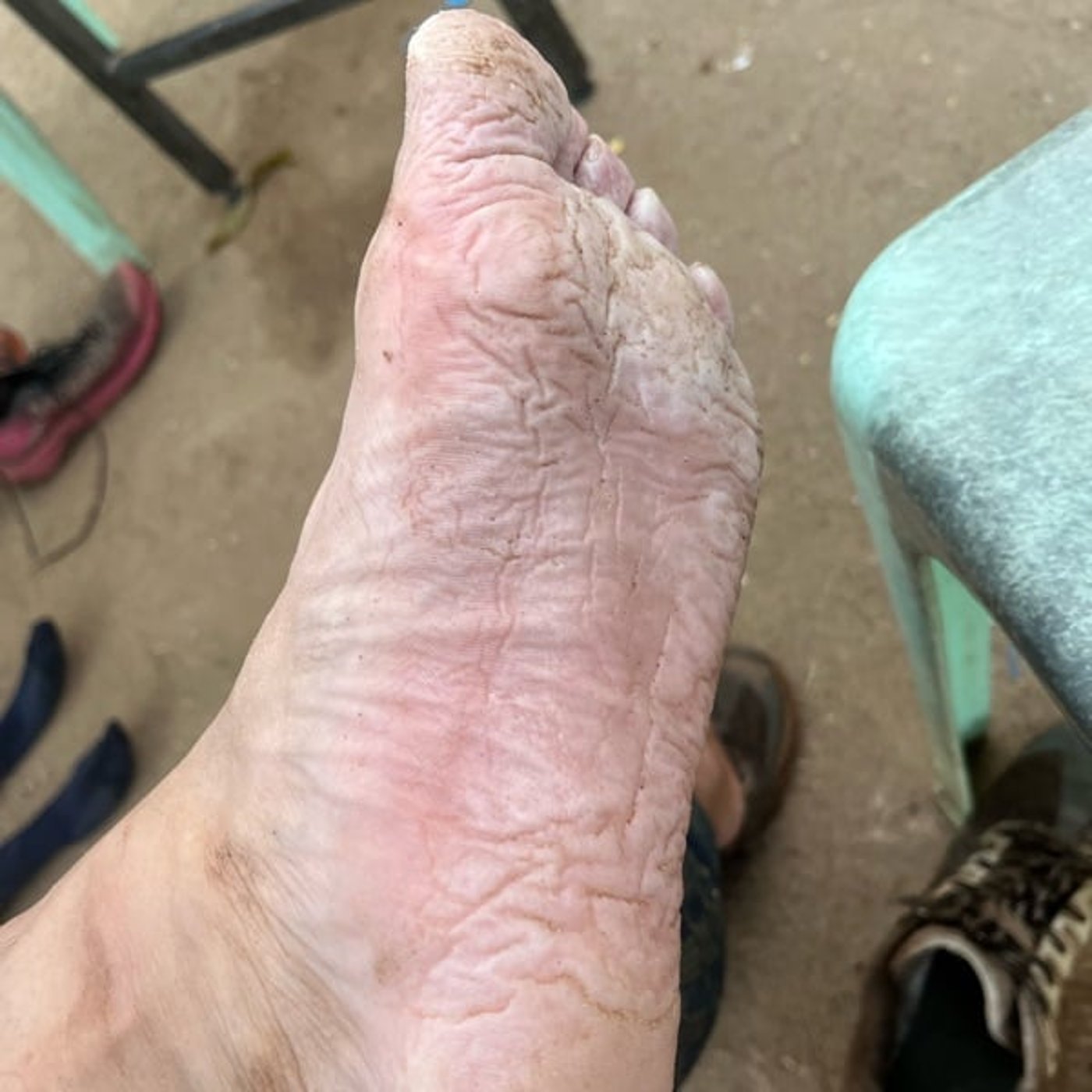 #137 トレランラボ#4 足裏ふやけ…いわゆる「塹壕足」対策